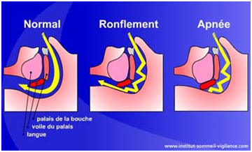 Schéma du syndrome d'apnées obstructives du sommeil